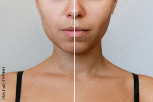 Young woman's face before and after plastic surgery buccal fat pad removal on a gray background. A lower part of face with clear highlighted cheekbones. Result of cheek surgery , comparison photo