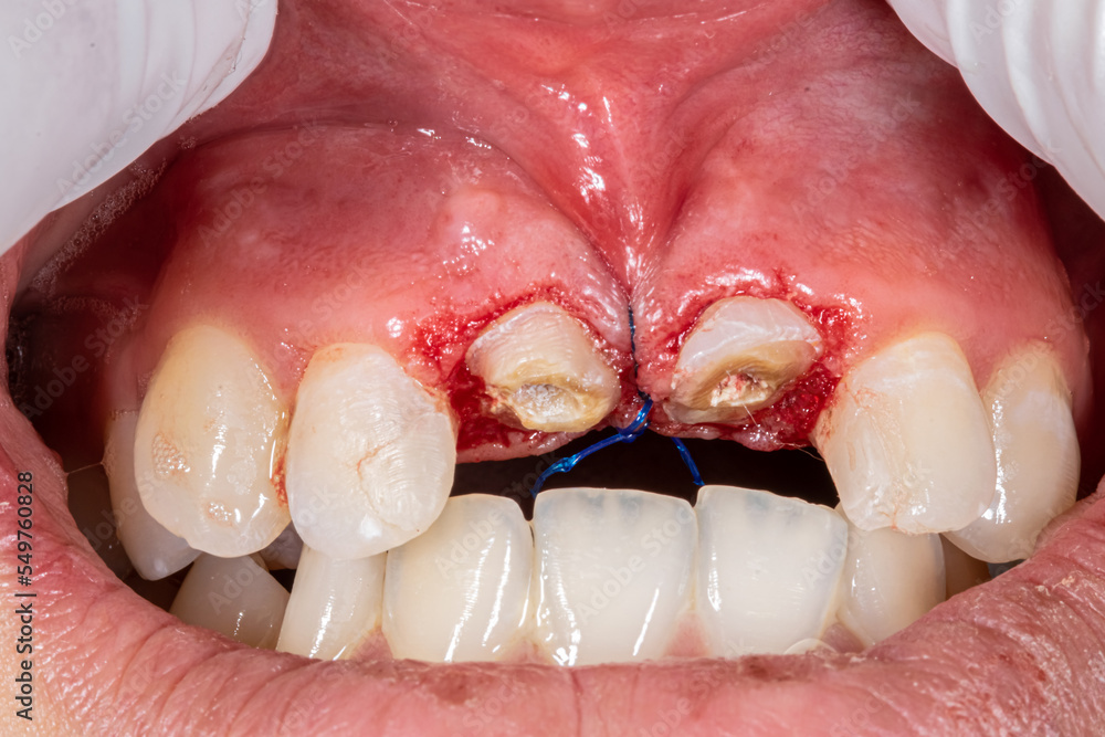 Front view of central incisal tooth and suture thread in the gingiva gum with maxillary mouth arch open with occlusion, retracted lips with fingers wearing gloves.