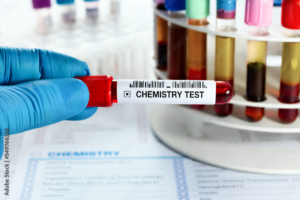 Technician Lab Holding Blood Sample Tube For Analysis Of Blood technician-lab-holding-blood-sample-tube-for-analysis-of-blood