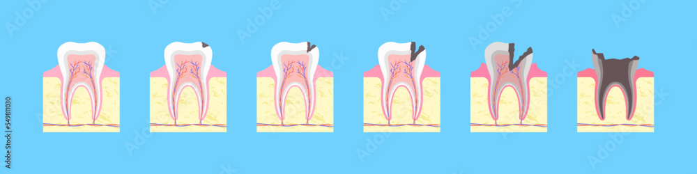 Process of carious destruction of tooth. Healthy bone formation with black fissure and gradual inflammation. Enamel decay with dental infection and complete vector loss Process of carious destruction of tooth. Healthy bone formation with black fissure and gradual inflammation. Enamel decay with dental infection and complete vector loss