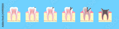 Process of carious destruction of tooth. Healthy bone formation with black fissure and gradual inflammation. Enamel decay with dental infection and complete vector loss
