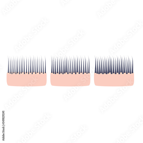Hair thickness types classification set. Skin cross-section with fine, normal, thick strands in diameter. Anatomical structure linear scheme. Outline vector illustration.