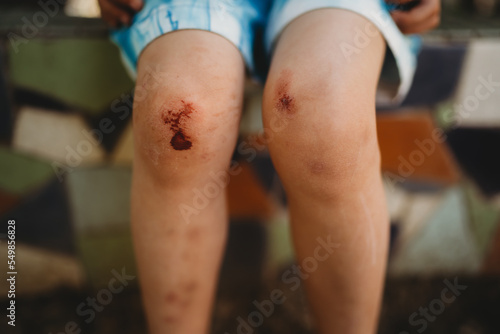 Child boy scraped bleeding knees from playing in summer with bruises photo