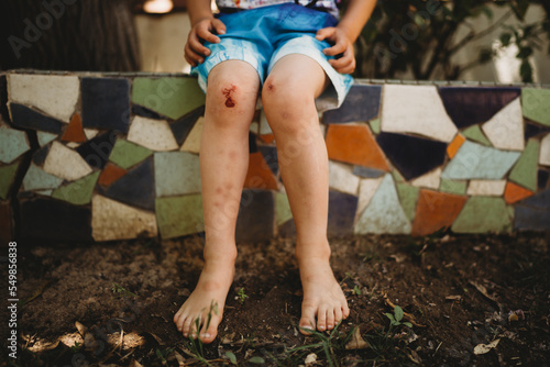 Child scraped bleeding knees from playing in summer legs with bruises
