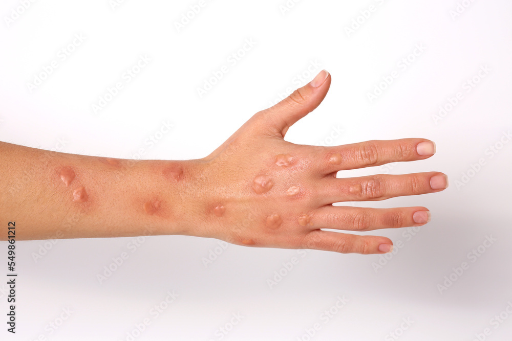 Woman with rash suffering from monkeypox virus on white background, closeup Woman with rash suffering from monkeypox virus on white background, closeup