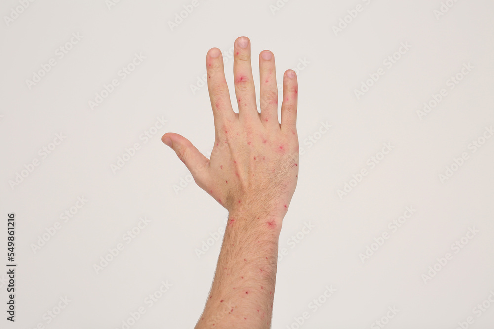 Man with rash suffering from monkeypox virus on beige background, closeup Man with rash suffering from monkeypox virus on beige background, closeup