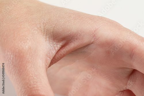 Little boy with dry skin on hand, closeup