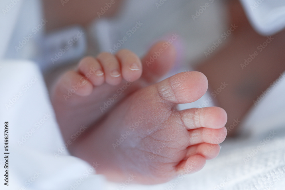 It is a dermatitis small warty bumps appear on the skin in child. Stock