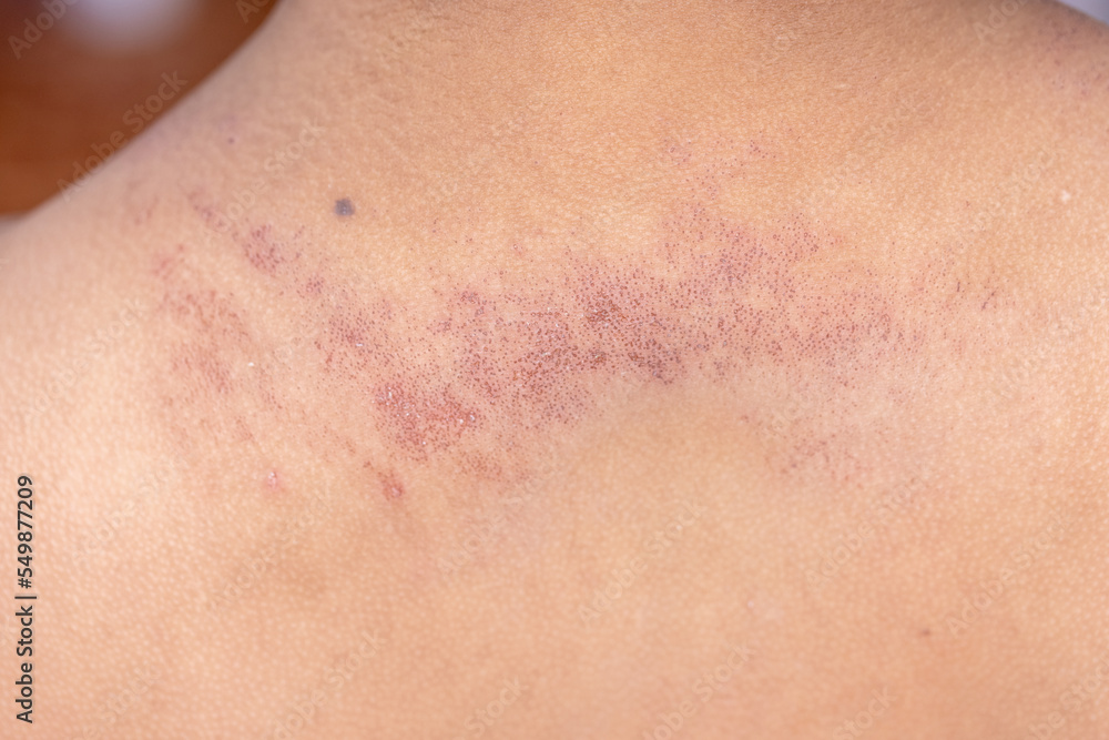 It is a dermatitis small warty bumps appear on the skin in child. It is a dermatitis small warty bumps appear on the skin in child.
