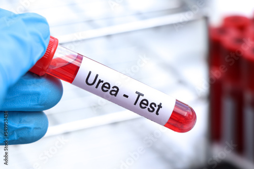 Urea test to look for abnormalities from blood
