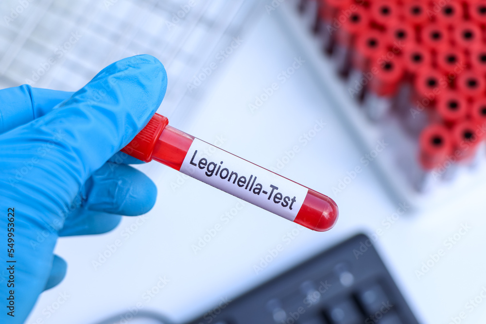 Legionella test to look for abnormalities from blood Legionella test to look for abnormalities from blood