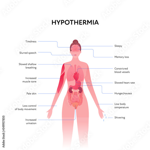 Frostbite and hypothermia health care infographic collection. Vector flat design healthcare illustration. Woman body anatomy slice scheme with inner organ with hypothermia warning sign with text