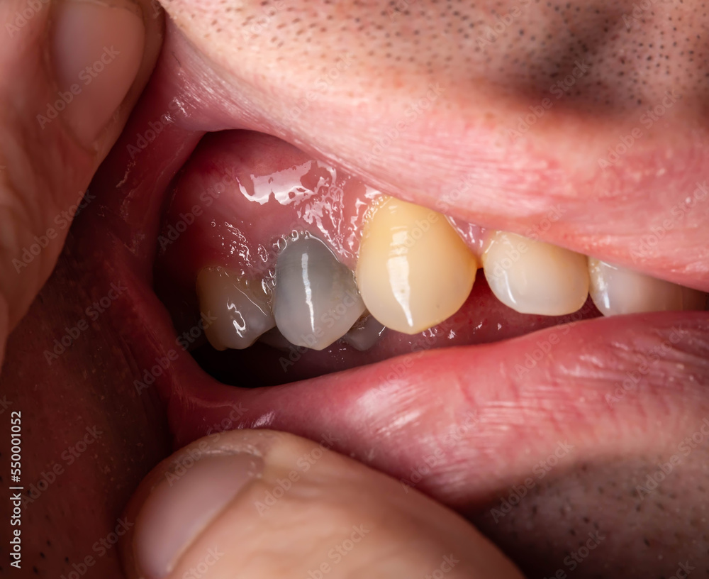 A black tooth in a man's mouth after removal of a nerve and filling of