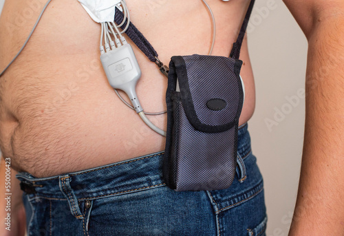 An obese man undergoes a Holter monitoring of the heart. Control of blood supply and disorders of the heart after myocardial infarction, electrocardiogram