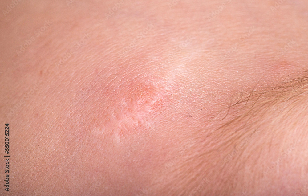 Scar on the forehead on the skin of a child, macro. Medical, laser scar resurfacing. Scar on the forehead on the skin of a child, macro. Medical, laser scar resurfacing.