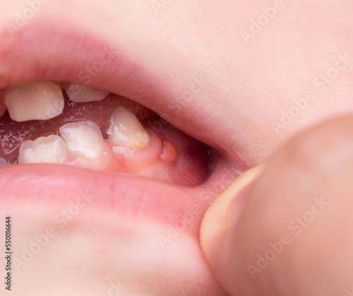 Red swelling on the gums of a child in the oral cavity. Fistula-bump due to bacteria of the diseased tooth. Deep caries. Close-up