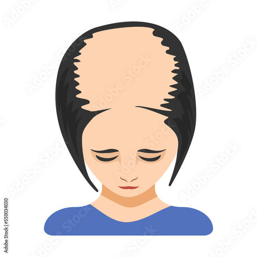 Severe baldness, alopecia in women vector illustration. Top of female head with bald spot on scalp isolated on white background. Health, hair loss or treatment concept