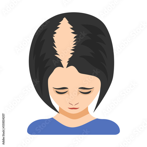 Second stage of alopecia in women vector illustration. Top of female head with bald spot on scalp isolated on white background. Health, hair loss or treatment