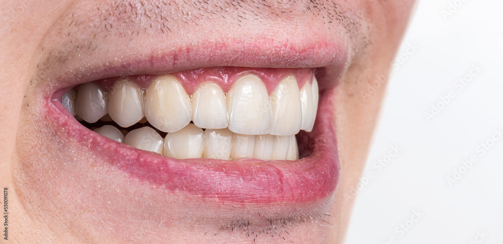 Obraz premium ceramic crowns and veneers