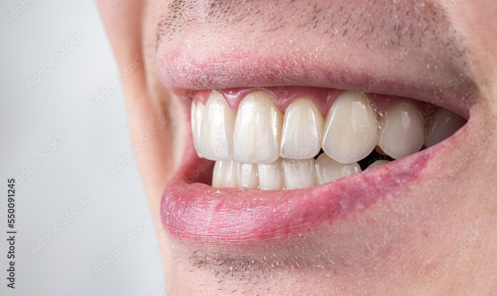 Obraz premium ceramic crowns and veneers