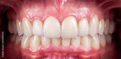 ceramic crowns and veneers