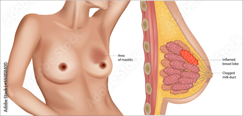 Mastitis. Cross-section of the mammary gland with inflammation of the breast. Abscess formation. Clogged milk duct. Inflamed breast lobe.