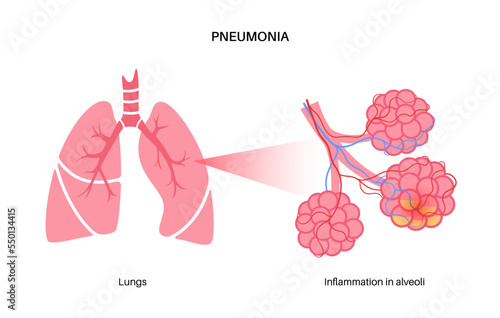 Pneumonia infection concept