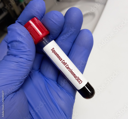 Squamous cell carcinoma antigen or SCCA testing for the diagnosis of squamous cell carcinoma. tumor marker test. photo