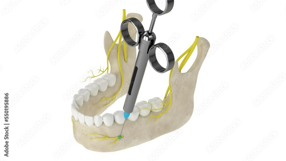 Vidéo Stock Mandibular arch with incisive nerve block. Types of dental