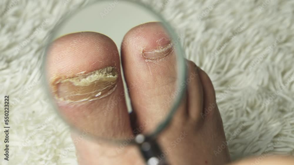 A man examines with a magnifying glass a toenail affected by a fungus. Close-up. Treatment of mycoses. A man examines with a magnifying glass a toenail affected by a fungus. Close-up. Treatment of mycoses.