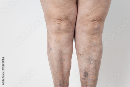 Medicine and health. The concept of female varicose veins. female legs with varicose veins, on a white background.VARICOSITY,senior woman.