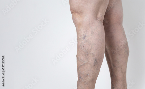 Medicine and health. The concept of female varicose veins. female profile legs with varicose veins, on a white background.VARICOSITY,senior woman,copyspace.