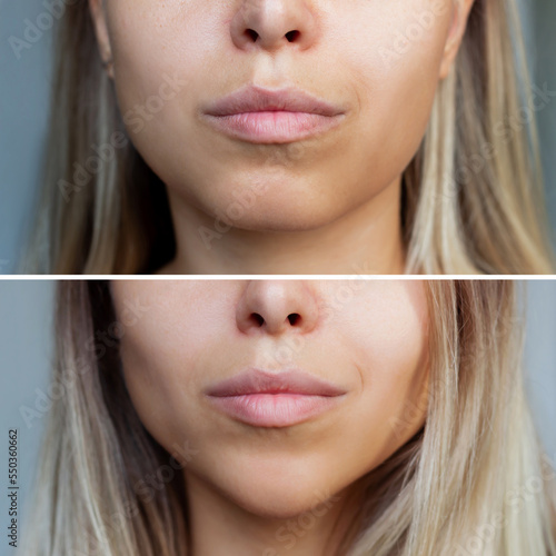 Chin reduction with fillers. Woman's face with jaws and chin before and after mentoplasty on a gray background. The result of cosmetic plastic surgery. Beauty concept photo