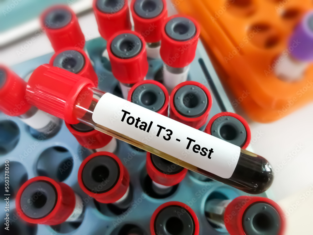 Blood sample in test tube for hormonal examination of thyroid gland in laboratory. Total T3