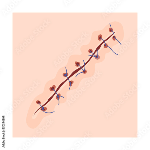 Skin scar with seam cartoon illustration. Bloody wound, injures, scratches, bruises, surgical sutures on legs or arms on skin background