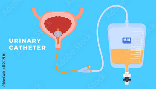 Urinary Medical sterile catheters for patient treatment. Medical tools for access to internal organs. Vector illustration photo