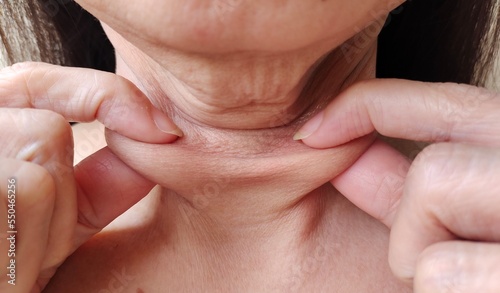close up the flabbiness adipose sagging skin, wattle and cellulite under the chin, wrinkles and cellulite under the chin of Middle-aged woman, health care and beauty concept.