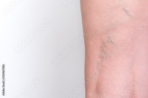 varicose veins, leg veins, back view of a woman, back view of a woman