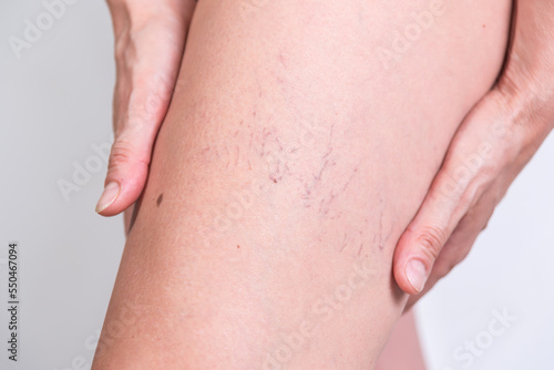 woman indicating varicose veins, veins, poor circulation, spider veins