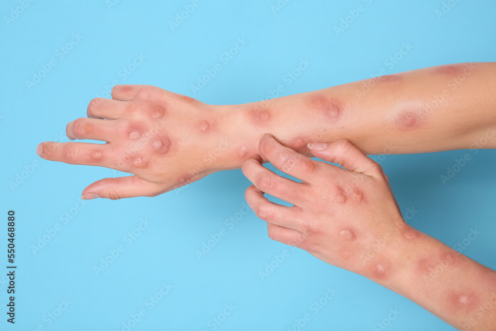 Woman with rash suffering from monkeypox virus on light blue background, closeup Woman with rash suffering from monkeypox virus on light blue background, closeup