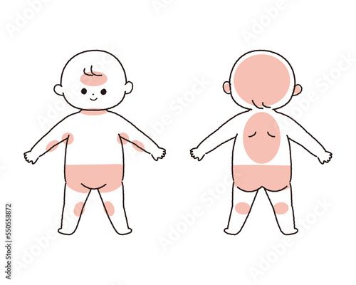赤ちゃんの汗疹が出来やすい部位を示したイラスト