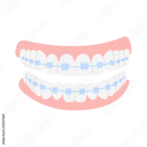 Braces for correction jaw and teeth, isolated on white background. Concept dental medecine, stomatology. Cartoon flat design. Vector illustration.