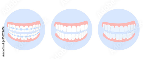 Braces, mouthguards, and aligners for correction jaw and teeth, in blue circles isolated on white background. Concept dental medecine, stomatology. Cartoon flat design. Vector illustration.