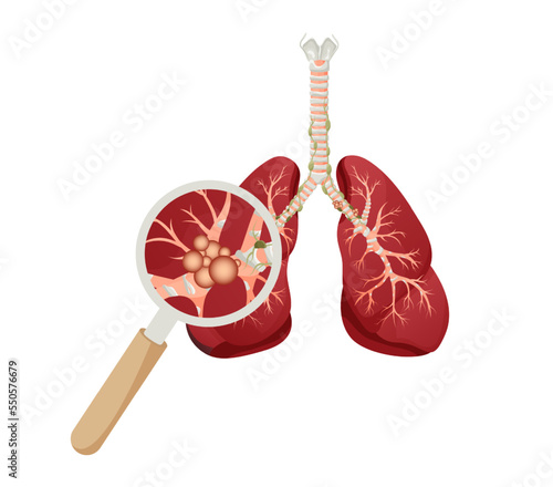 Lung cancer diagram. Detailed illustration