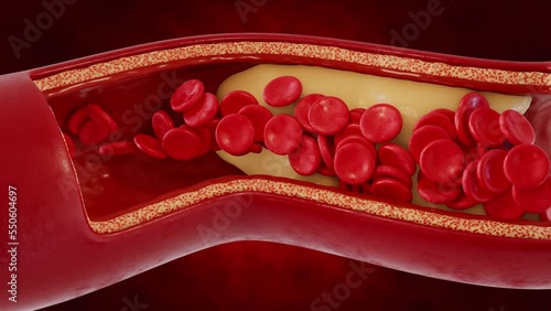 The formation of cholesterol plaques on the walls of blood vessels. 3d visualization of atherosclerosis. Medical concept. photo
