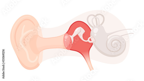 耳の構造のイラスト_急性中耳炎_炎症した鼓膜と中耳 photo