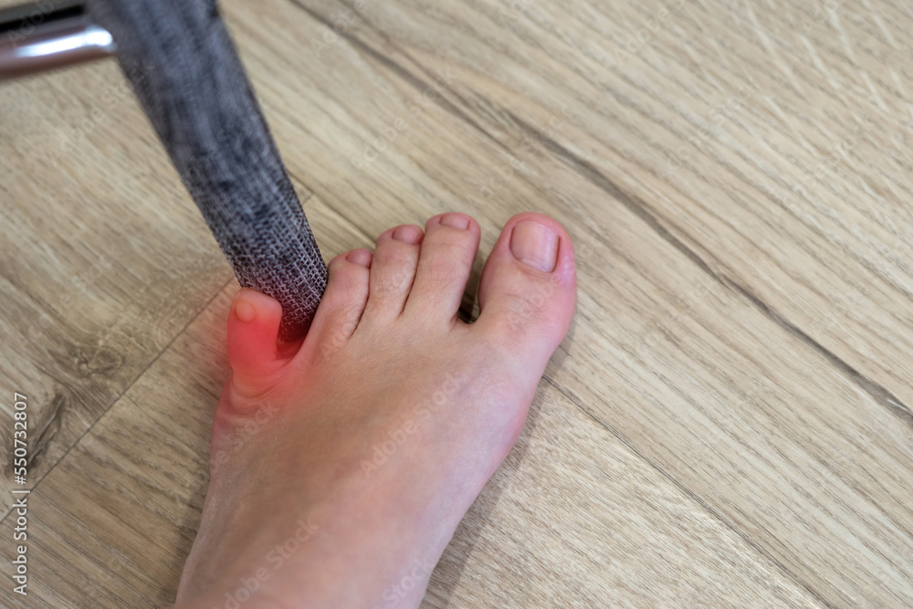 Woman hit chair with the little toe. Incident at home. Red spot showing