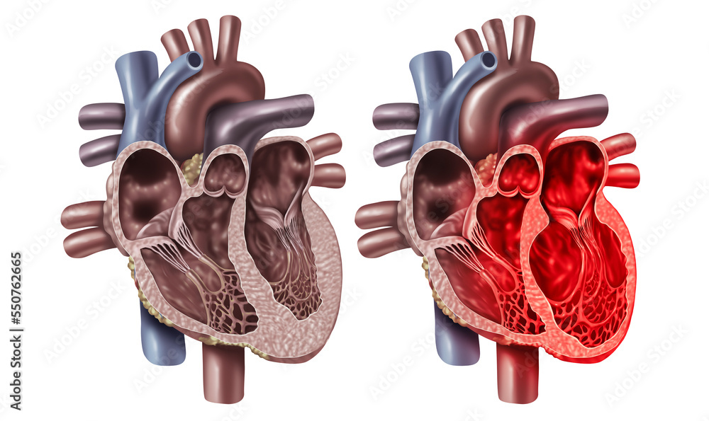 Broken Heart Syndrome or Takotsubo cardiomyopathy with a healthy organ