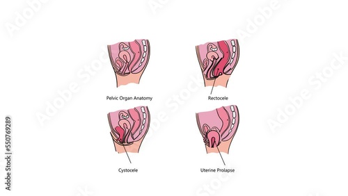 PELVIC ORGAN PROLAPSE VARIOUSLY VIDEO General Diagram With Explanatory Text And An Increase In Affected Area For Medical Education Anatomy Human Moving Banner photo