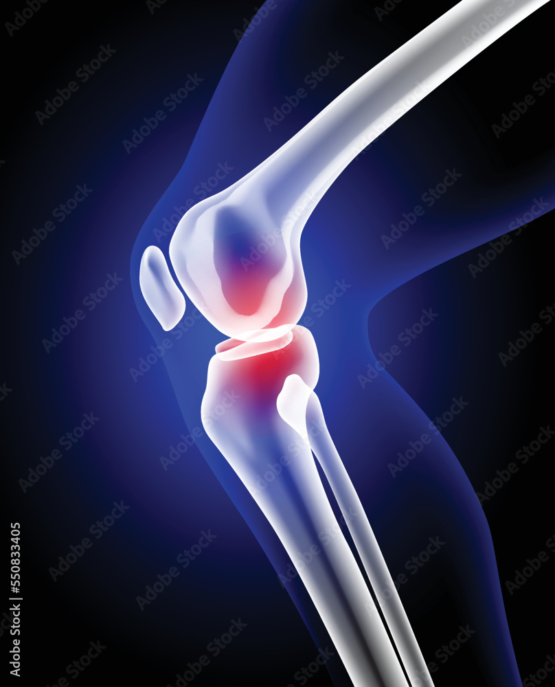 X-ray illustration of leg and knee bone showing pain. medical use ...